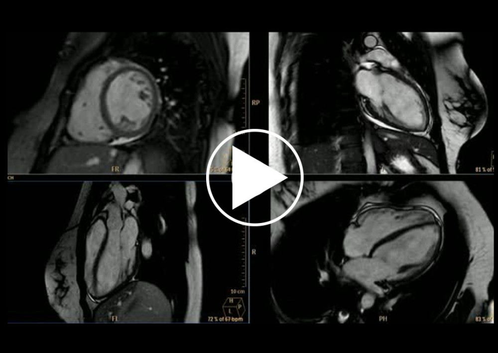 Cardiac magnetic resonance imaging of the index patient’s daughter. SSFP cine video at short-axis, 2-chamber, 3-chamber and 4-chamber views. Normal biventricular ejection fraction, no regional wall motion abnormalities. No left ventricular hypertrophy.