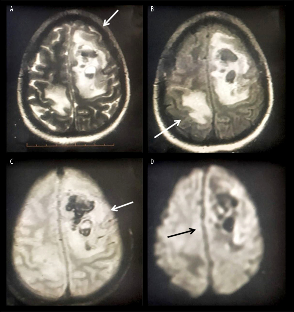 Cerebral MRI of the index patient, yielding findings suggestive of AHNE. T2-weighted images showing non-enhancing altered intensity lesions in the left high fronto-parietal (arrow) and right posterior parietal (arrows) areas with peri-lesional edema (A, B) and signal blooming in gradient recalled echo (GRE) MRI with mass effect over the adjacent falx towards the right side (C, D).