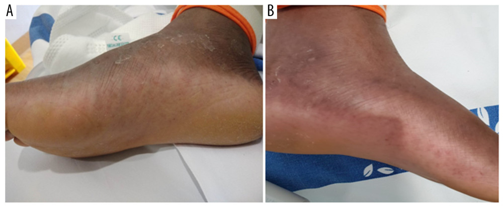 Skin manifestations of RBF on the (A) right foot and (B) left foot of the affected patient.