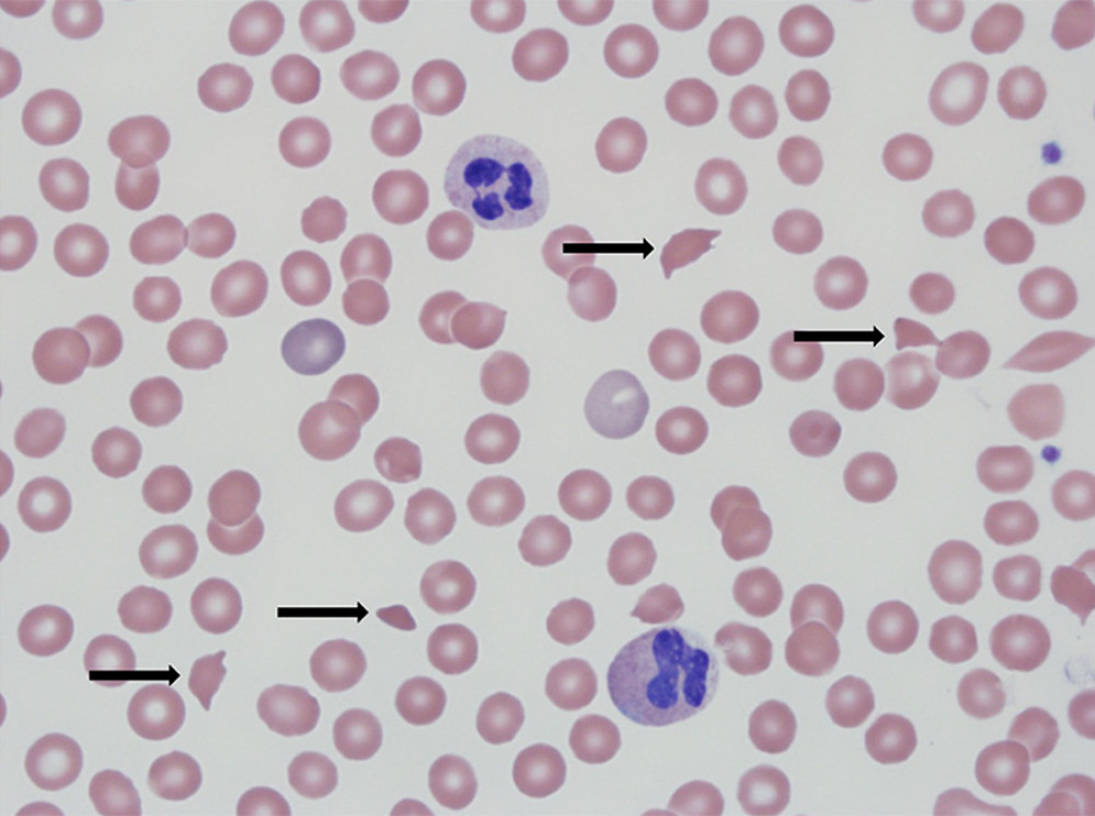 Peripheral smear from our patient with microangiopathic hemolytic anemia, demonstrating decreased erythrocyte numbers consistent with anemia and decreased platelets consistent with thrombocytopenia. Arrowheads highlight fragmented red blood cells (i.e., schistocytes) that have an irregular shape and lack central pallor. Wright Giemsa stain, original magnification ×400.