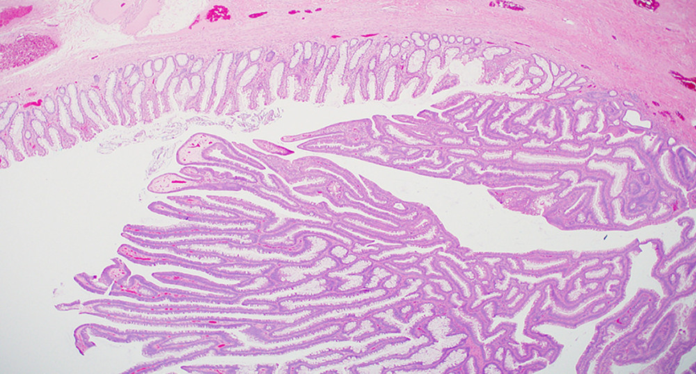 A low-power microphotograph showing part of the rectal mucosa and an adjacent tubulovillous adenoma. H&E stain, magnification ×20.