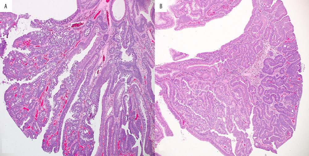 (A) Few foci of high-grade dysplasia are noted and show glandular budding, irregular branching of the crypts, and depletion of goblet cells. (B) Other areas show back-to-back glands and invasion limited to the lamina propria (i.e., carcinoma in situ/intramucosal carcinoma). H&E stain, magnification ×100.