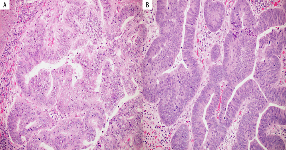 (A, B) High-power magnification microphotographs show severe nuclear atypia with nuclear enlargement, and nuclear hyperchromasia, as well as vesicular nuclei with prominent nucleoli and nuclear pseudostratification. Several mitoses are also seen. H&E stain, magnification ×200.