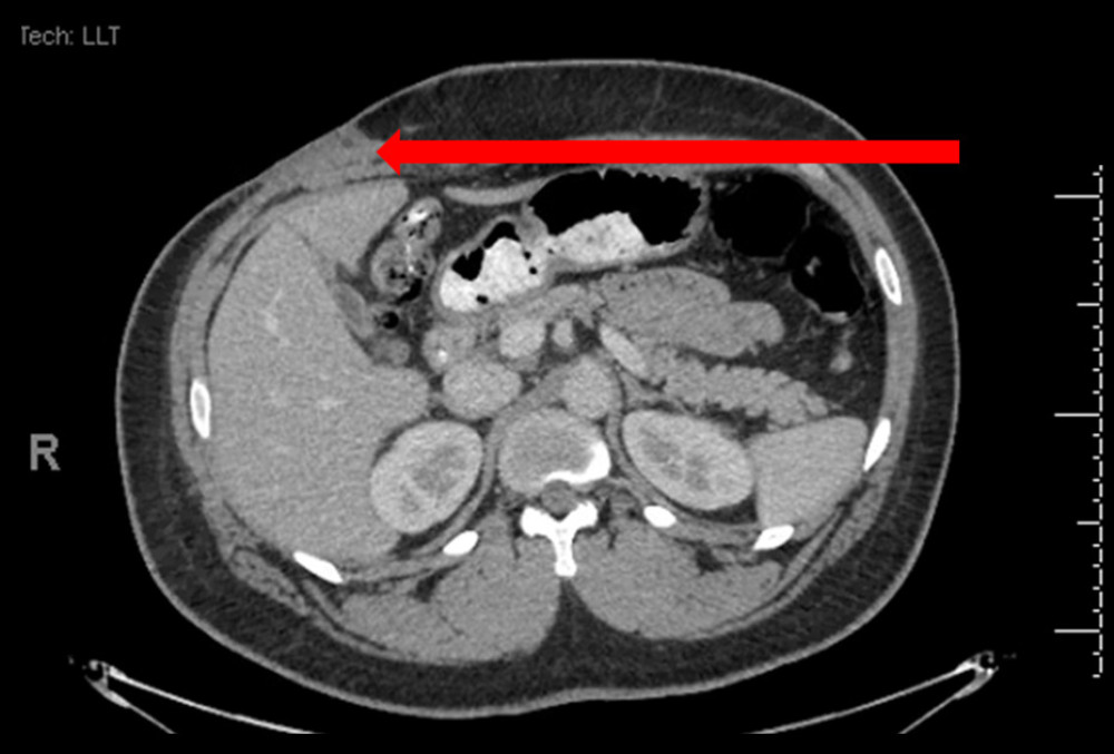 CT scan of the right upper abdominal quadrant, showing a subcutaneous based solid-cystic attenuating mass measuring 7.8 cm with complex abscess formation (red arrow).