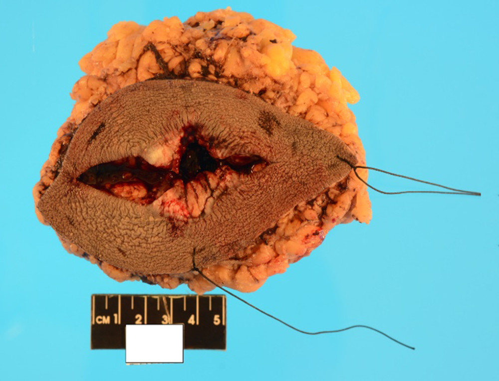 Gross specimen showing ellipse of the skin with an underlying tumor measuring 12.2×9.4×5.5 cm and a longitudinal surgical defect in the center.
