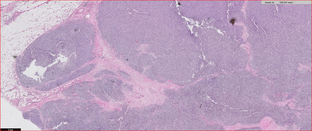 Histology of the tumor, showing a nodular growth pattern with infiltration into the surrounding adipose tissue (H&E staining, 4×).
