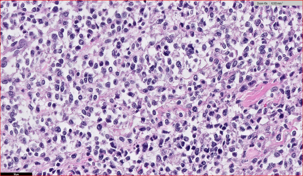 Histology of the tumor, showing round-ovoid to spindle cells with prominent nucleoli, and ill-defined, eosinophilic cytoplasm (H&E staining, 40×).