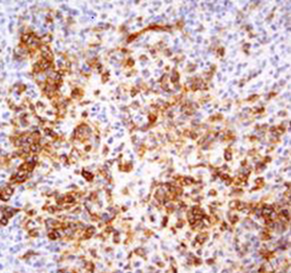 Immunohistochemical staining of the tumor with anti-CD99 antibody, showing patchy membranous positivity of tumor cells with focal staining.