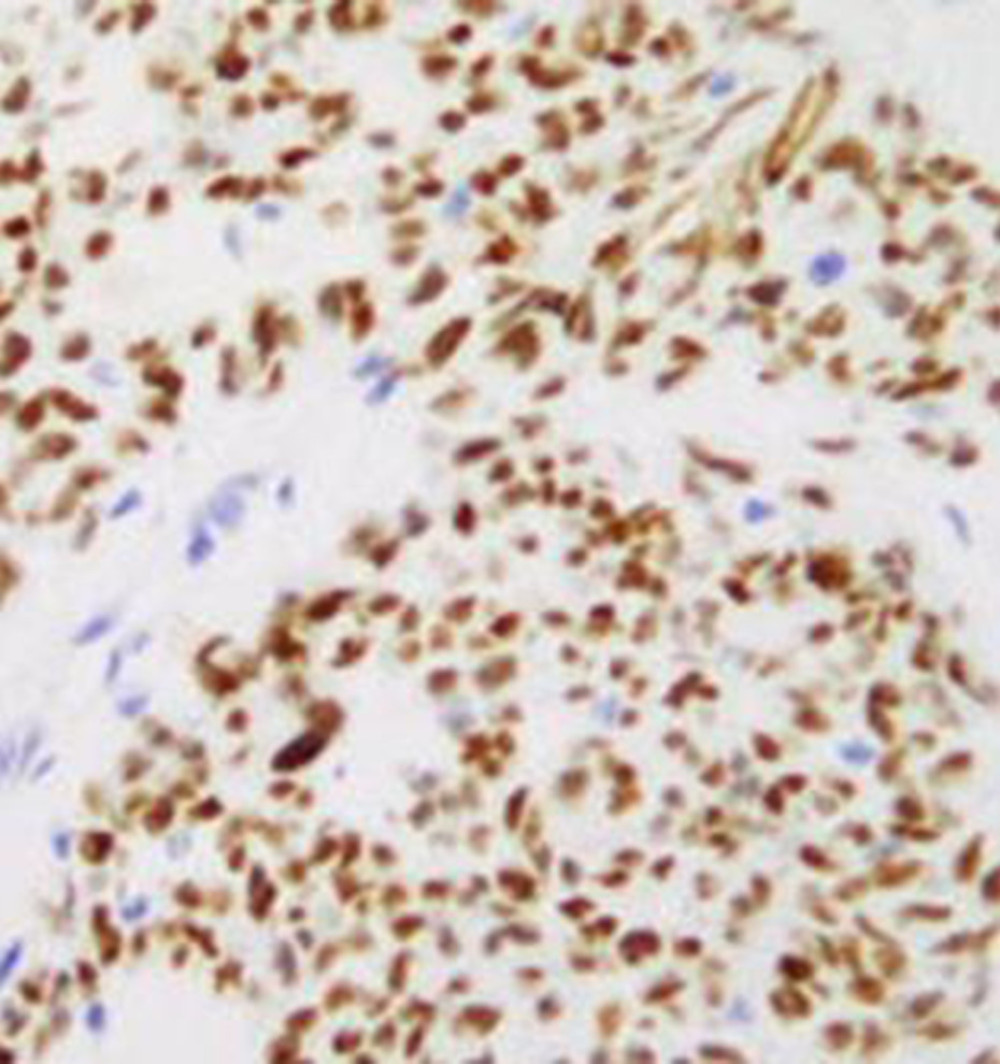 Immunohistochemical staining of the tumor with anti-WT1 antibody, showing nuclear staining of most tumor cells.