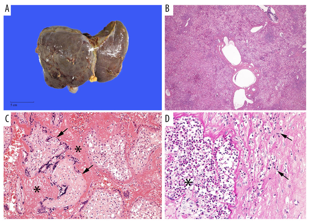 Representative macroscopic and microscopic images of the patient’s liver and placenta. (A) Gross morphology of the liver with submassive hepatic necrosis demonstrating capsular wrinkling and flattening (*) with developing regenerative nodularity (arrow) in portions of the liver. (B) Histologic examination of the liver demonstrating submassive hepatic necrosis characterized by complete loss of hepatocytes and inflammation (right and upper portion of image), with early regenerative nodularity (lower left portion of image). (Original magnification ×40.) (C) Histologic examination of the placenta demonstrating evidence of chorioamnionitis characterized by subchorionic fibrin (*) with admixed neutrophils and neutrophilic infiltration of the chorionic plate (arrows). (Original magnification ×400.) (D) Histologic examination of the placenta demonstrating extensive accumulation of intervillous blood with perivillous fibrin deposition (*) and early ischemic change of villi (arrows). (Original magnification ×200.)