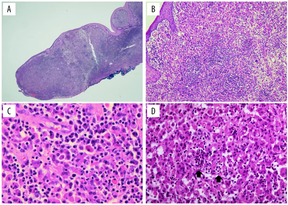 Histopathologic results of the microscopic examination. (A) At low magnification, a well demarcated nodular mass is seen and there is no evidence of lymph node within the excised specimen (H&E, 12.5× magnification). (B) Extensive inflammatory cell infiltration in the subepithelial stroma (H&E, 200× magnification). (C) A mixture of numerous histiocytes, plasma cells and a few neutrophils are identified (H&E, 400× magnification). (D) Enlarged histiocytes exhibiting characteristic emperipolesis (black arrow) (H&E, 400× magnification).