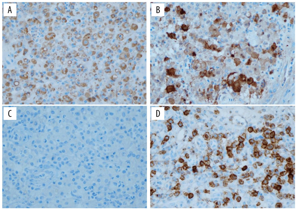 Immunohistochemical (IHC) staining results. Cytoplasm positive for CD68 (A) and S100 (B) in histiocytes, but negative for CD1a (C) (A–C, 400× magnification) can be seen. (D) Scattered plasma cells between histiocytes are highlighted by CD138 IHC staining (400× magnification).