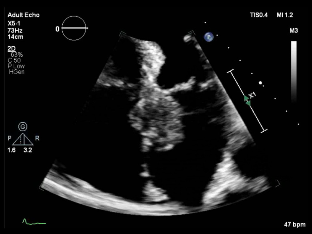 Large interatrial septal mass on the initial echocardiogram. Apical 4-chamber view by transthoracic echocardiogram obtained on presentation showed a large cardiac mass (3.6×3.7 cm) in the interatrial septum.