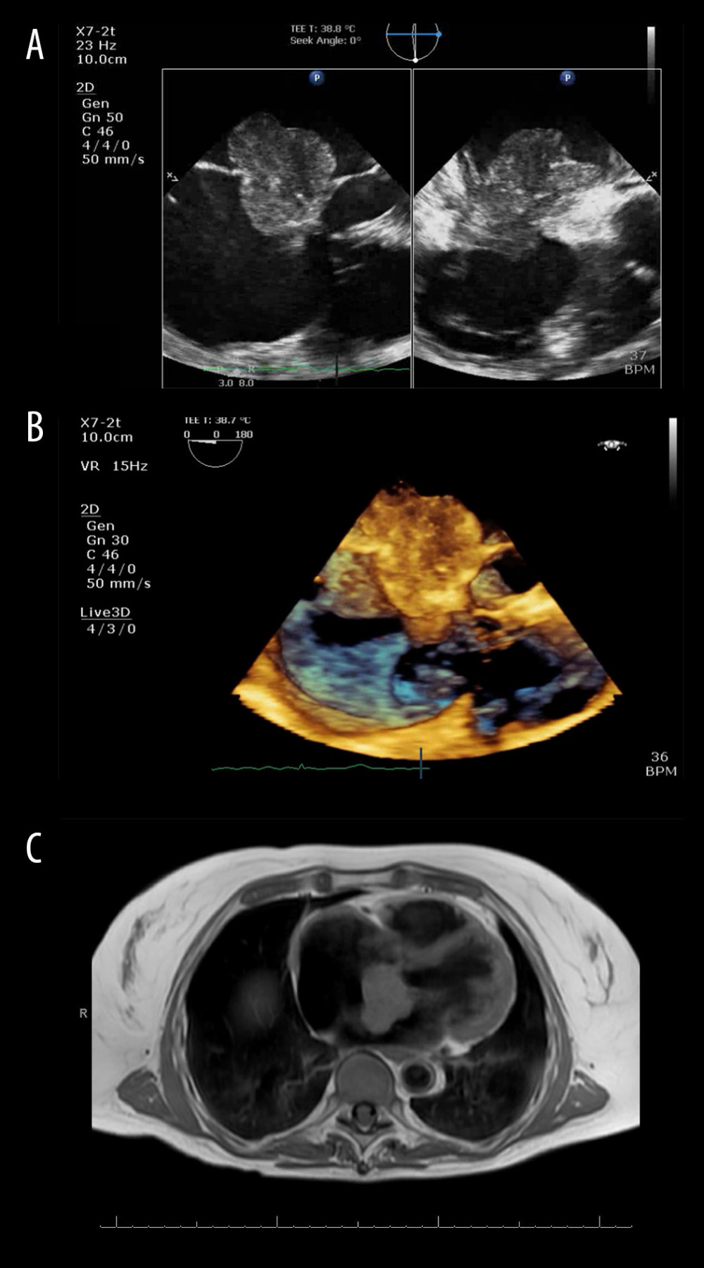 Other cardiac imaging demonstrated the cardiac mass. (A) Transesophageal echocardiogram re-demonstrated the mass. (B) Three-dimensional acquisition of the cardiac mass obtained during transesophageal echocardiogram. (C) Cardiac magnetic resonance imaging confirmed a 3.8×4.3×5.6 cm mass between the atria.