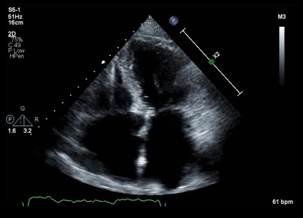 Resolution of the cardiac mass after chemotherapy. Apical 4-chamber view from a repeat transthoracic echocardiogram completed 6 weeks after chemotherapy demonstrated resolution of the cardiac mass after lymphoma treatment.