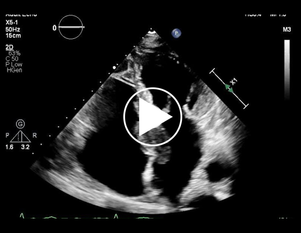 A clip of the apical 4-chamber view via transthoracic echocardiogram was obtained, showing a large interatrial septal mass.