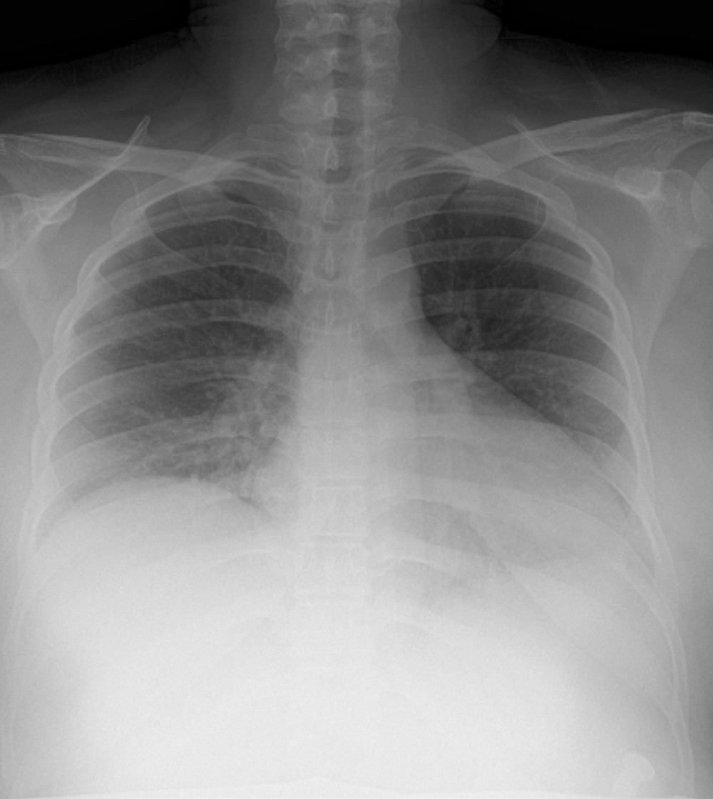 0The chest X-ray (anterior-posterior view) from a 31-year-old woman who presented with mild symptoms of COVID-19 pneumonia and who tested positive for SARS-CoV-2 two days before giving birth. The lungs show changes consistent with viral pneumonia and include reduced lung expansion and bilateral basal opacities.