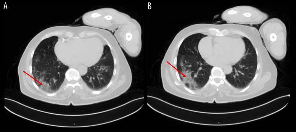 (A) Chest computed tomography (CT) findings in a 73-year-old man with COVID-19. Chest CT axial image reveals bilateral consolidations and ground-glass opacities in the lower lobes (red arrow). (B) Computed tomography axial image shows consolidation more prominent in the right lower lobe (red arrow).
