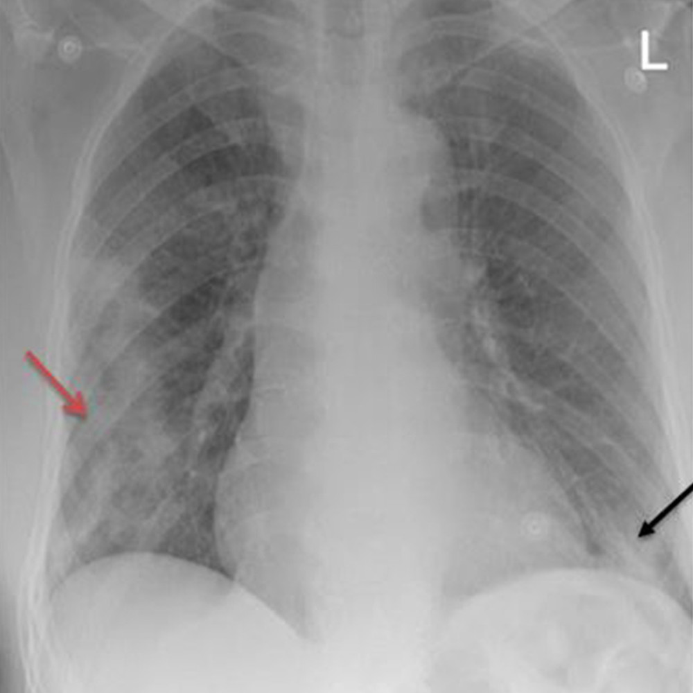 Chest X-ray shows right subpleural peripheral heterogeneous opacities along the mid- to lower-lung zones (red arrow) and left lower-zone consolidation (black arrow).