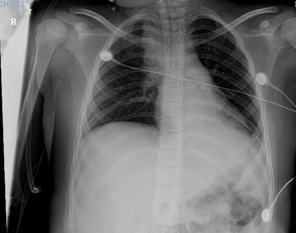 A chest X-ray revealing right upper-lobe infiltration.