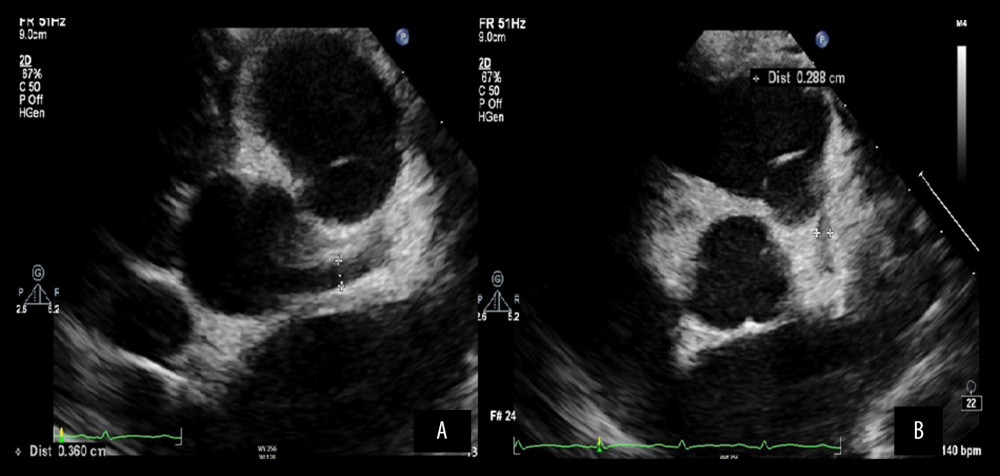(A) Main left coronary artery dilation. (B) Proximal left anterior descending coronary artery dilation.