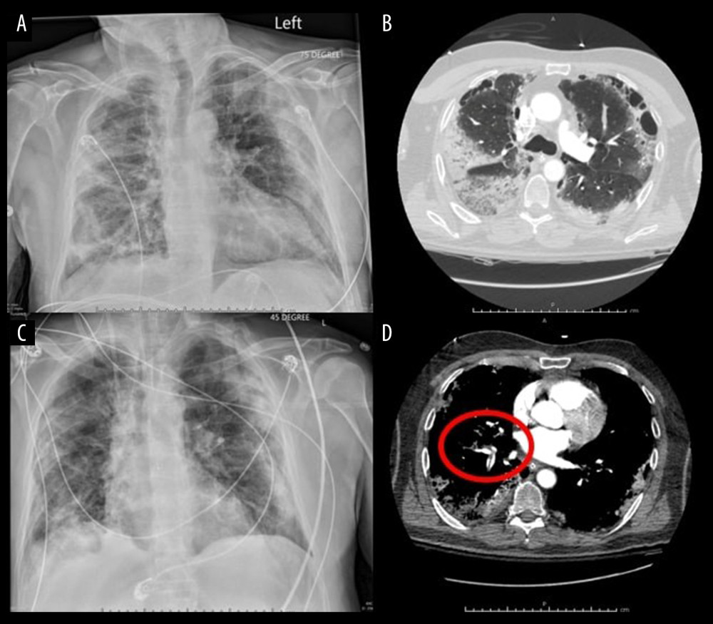 Selected imaging studies from a 67-year-old man who presented to the hospital 2 weeks after testing positive for SARS-CoV-2. (A) Chest x-ray on presentation to the hospital; (C) Chest x-ray 5 days after admission to the hospital. (B, D) Computerized tomography angiography scan on presentation to the hospital showing diffuse lung disease (B) and pulmonary artery emboli (red circle) (D).