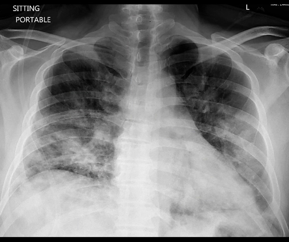 Chest x-ray during the initial admission shows bilateral infiltrate mainly prominent in lower lobes at time of initial presentation.
