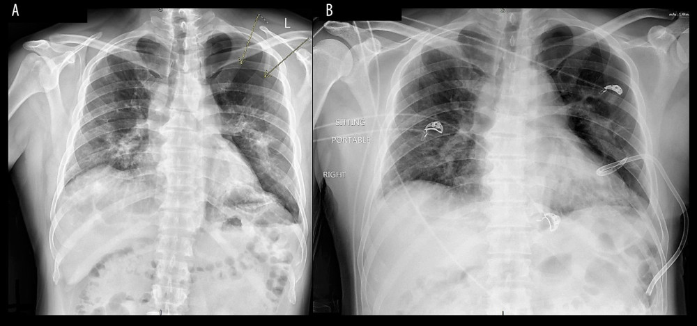 Left-sided pneumothorax (A) and after pigtail insertion (B). There was an interval decrease of the left pneumothorax, from 21 mm to 8 mm in thickness, at the apex after the pigtail insertion.