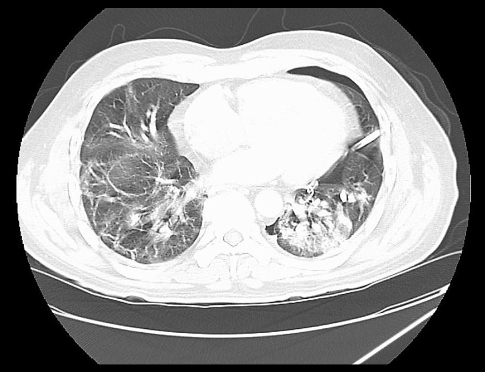 CT scan of the chest without contrast after pigtail insertion. Left pleural catheter is in position with approximately 27% volume left pneumothorax. Bilateral upper and lower lobe airspace infiltrates/consolidation are noted, left more pronounced than right.