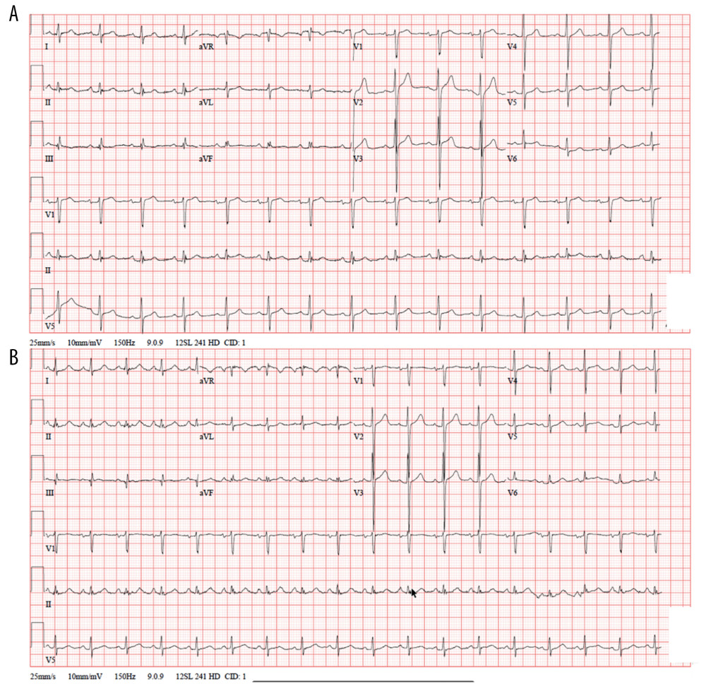 (A) Electrocardiogram (ECG) on admission showing a QTc interval of 394 milliseconds before initiation of hydroxychloroquineazithromycin therapy. (B) ECG on day 12 showing a gradual prolongation of QTc interval to 433 milliseconds.