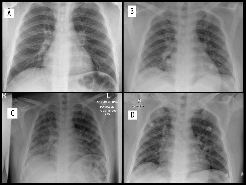 (A) Day 1. Bilateral accentuation of vascular markings of the lung fields, more seen on the lower zones. No pleural effusion. No pneumothorax. Early features suggestive of viral pneumonia. (B) Day 4. More prominent hilar shadows on the right. Accentuated prominent broncho-vascular markings, thick pulmonary reticulations, and peri-bronchial thickening with some confluence at the perihilar and both lung bases with basal interstitial infiltrates predominantly. (C) Day 9. Progression of the previously seen bilateral multiple pneumonic consolidation. (D) Day 17. Mild Improvement in lower zone infiltrates.