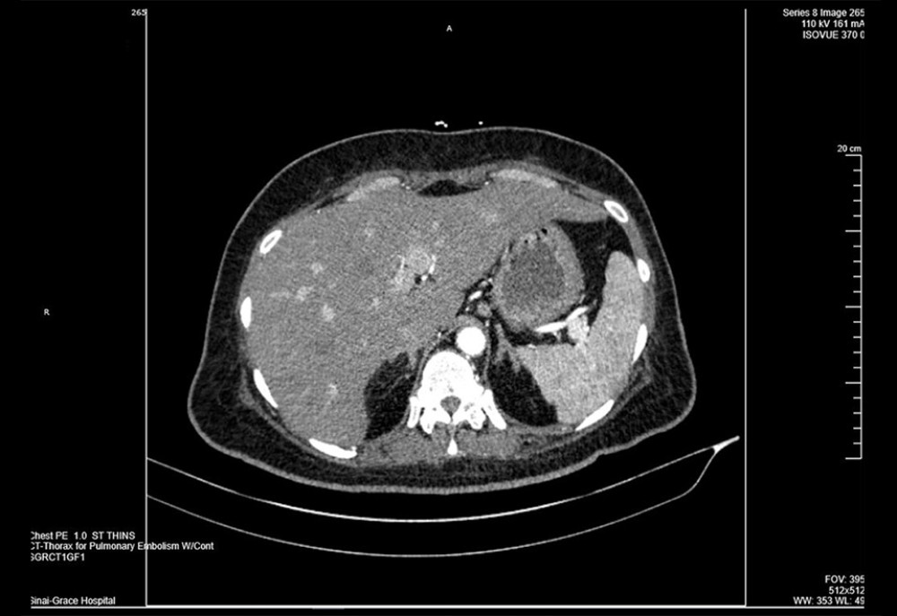 Computed tomography displays spleen prominent in size and shows few small hypoattenuation areas peripherally and its inferior region highly likely related to focal infarcts. The liver is slightly large and shows focal hypoattenuation anterior–inferior left liver medial section near the fissure compatible with focal fat infiltration.