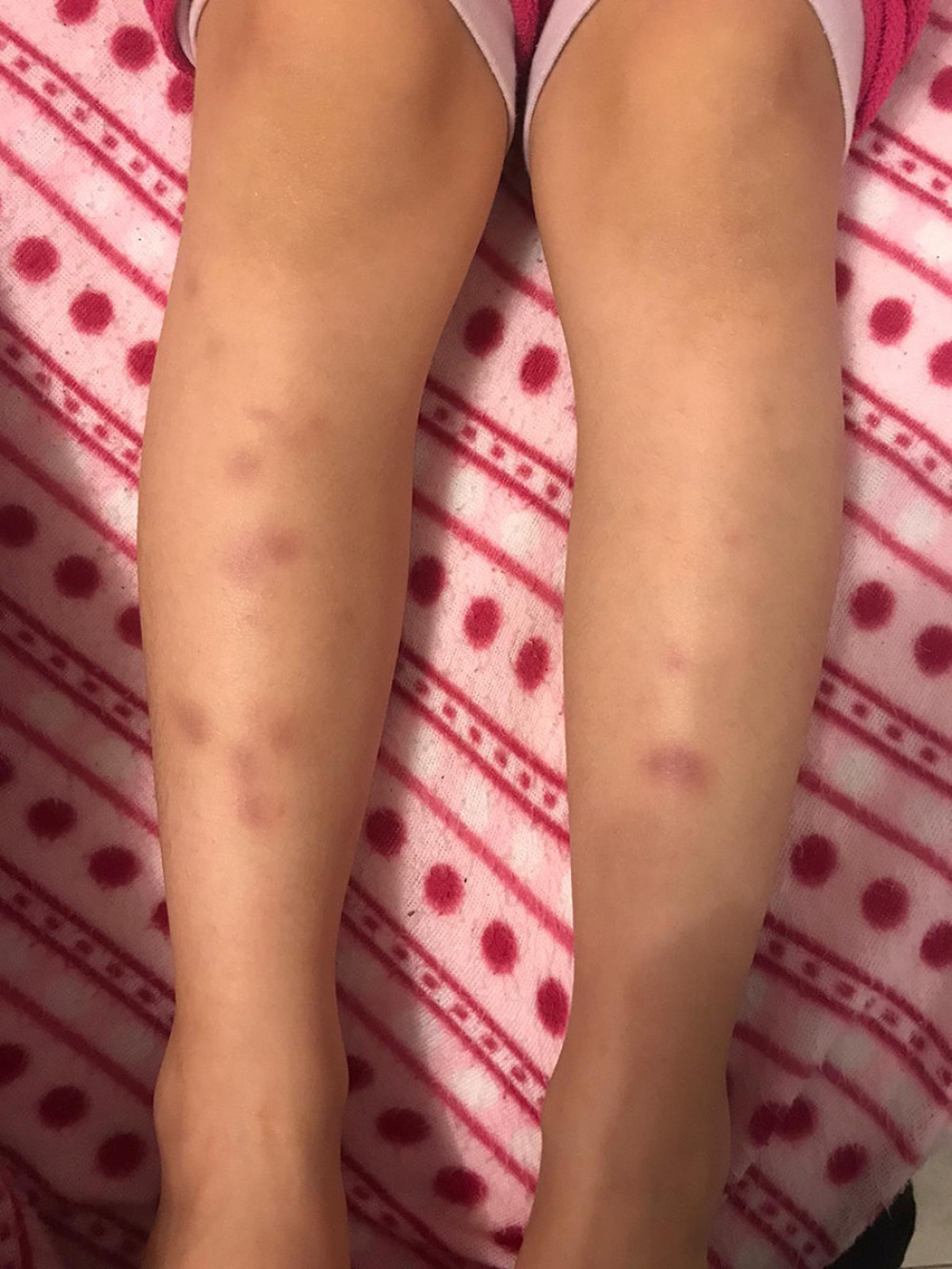 Multiple patchy erythematous lesions spreading on both lower limbs of the patient.