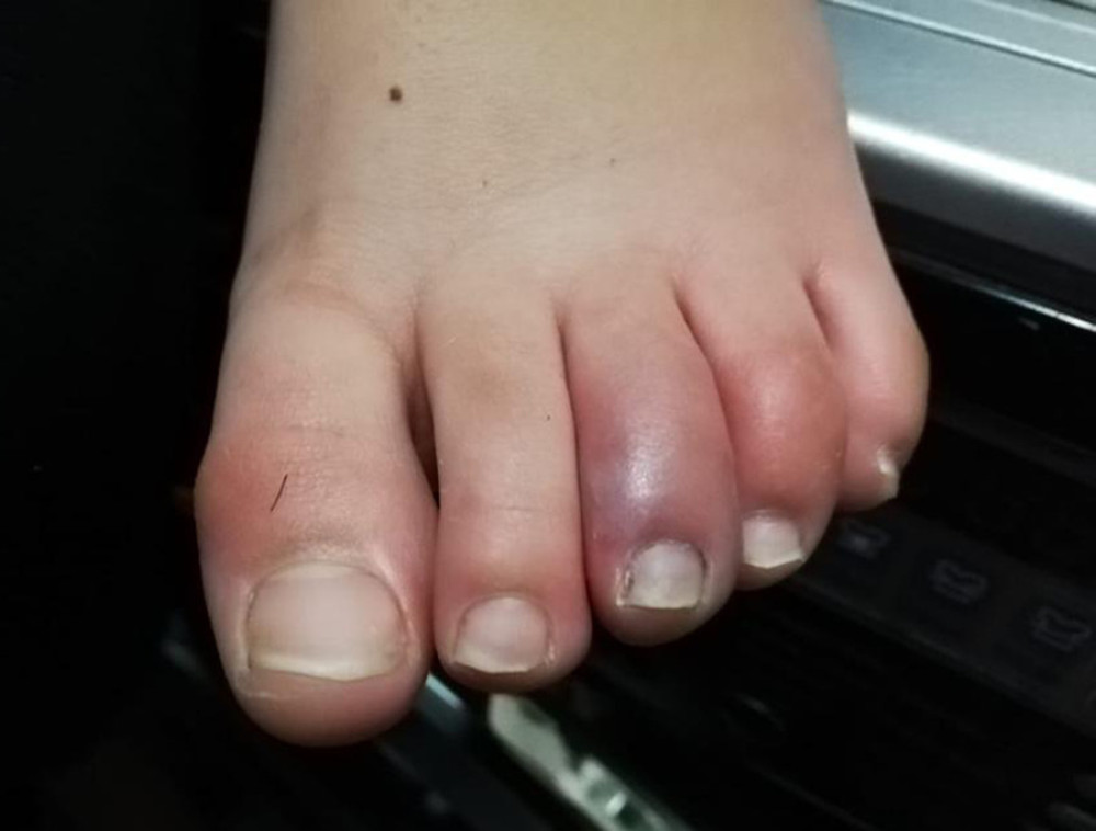 Erythematous and edematous lesions of the toes with associated pain and itching. Characteristic purple erythematous manifestations located on the extremity of the third toe.