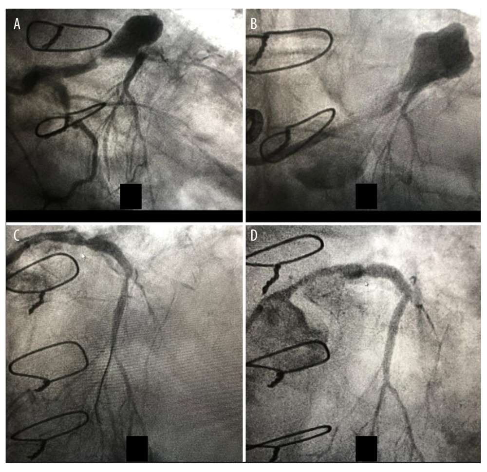 (A) 2015 left coronary angiogram showing a saccular aneurysm (10×8 mm) of the proximal LAD. (B) 2019 left coronary angiogram showing the aneurysm increased in size (15×12 mm). (C) 2019 left coronary angiogram showing covered stent implantation after rotablator atherectomy with significant residual stenosis. (D) 2020 left coronary angiogram showing a good aneurysm exclusion with stent recoil and stable in-stent restenosis.