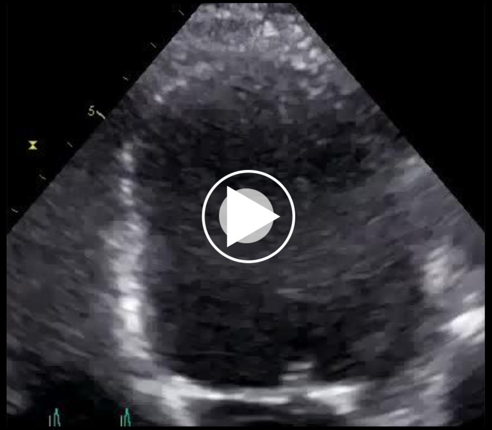 TTE showing an altered left ventricle ejection fraction at 25% with inferior and infero-lateral walls akinesia.