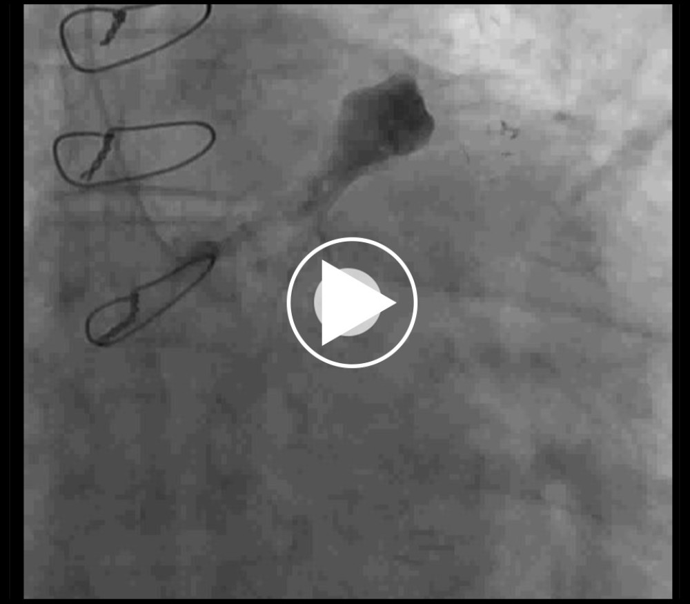 2019. Left coronary angiogram showing the LAD aneurysm expanded in size.