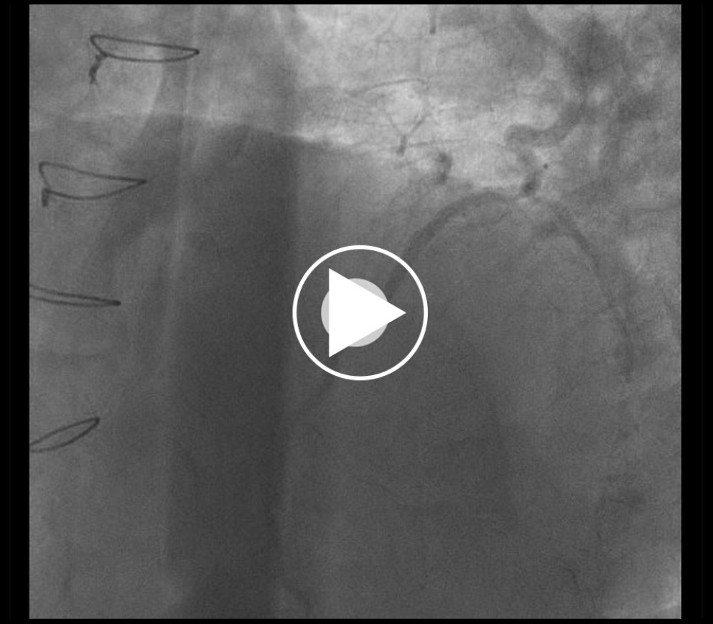 2019. Coronary angiogram showing patent LIMA graft to middle LAD and diagonal coronary artery.