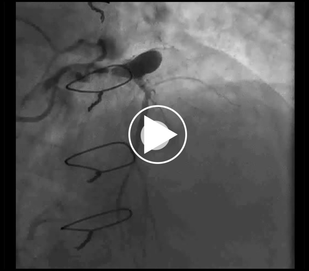 2015. Left coronary angiogram showing initial size of LAD aneurysm.