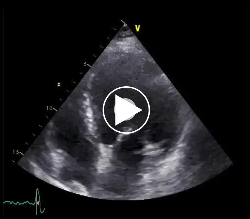 TTE showing an improved LVEF at 35%.