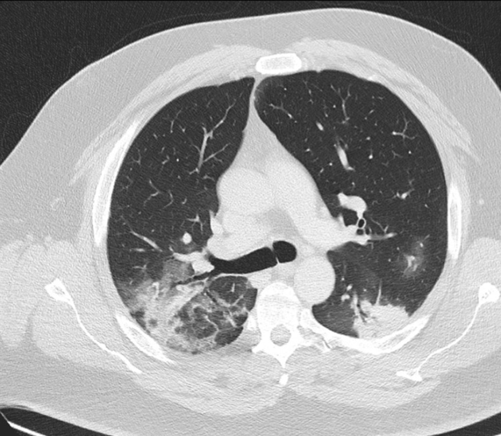 Chest computed tomography on admission, showing bilateral infiltrates.