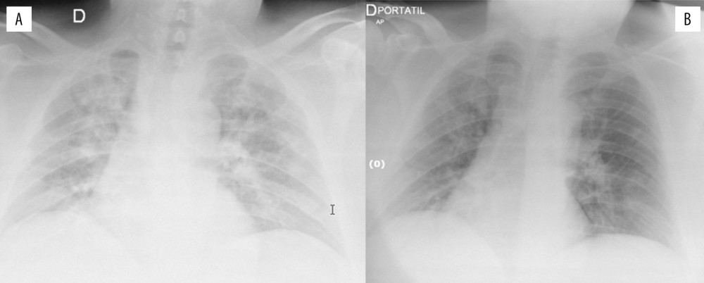 Chest X-ray before (A) and after only 2 sessions of oxygen–ozone therapy (B).