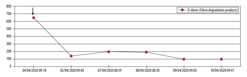 D-Dimer levels dropped from 657 ng/mL to >100 ng/mL after start of ozone therapy.