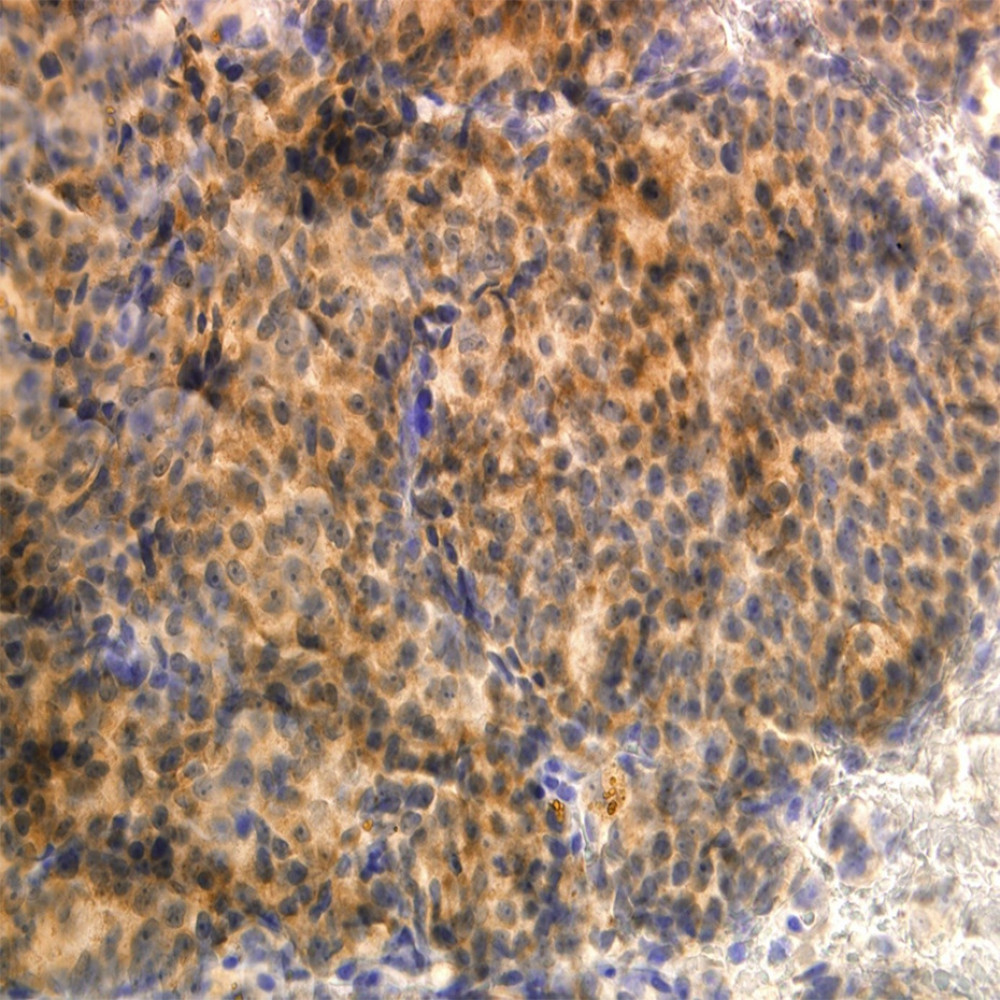 Immunohistochemical staining with anti-chromogranin A (CgA) antibody. More than 50% of the tumor cells were positive for CgA (×400).