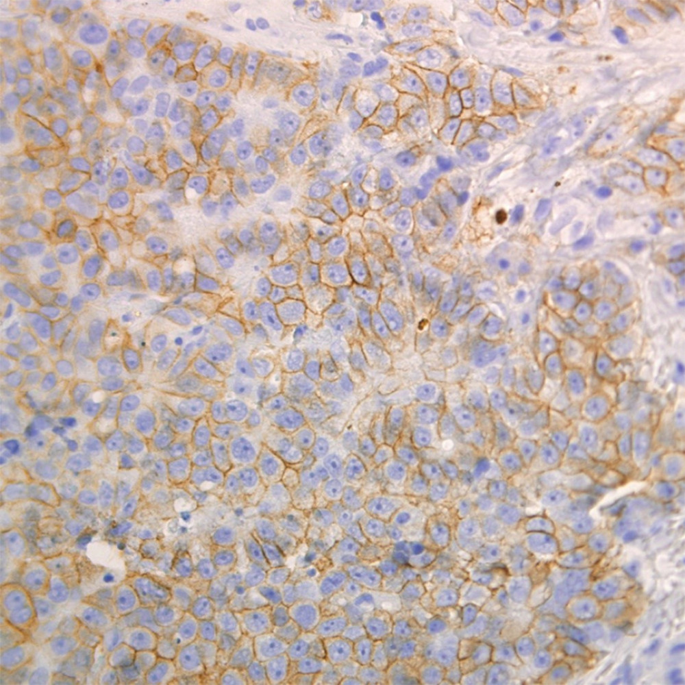 Immunohistochemical staining with anti-HER2/neu antibody. The HER-2 status was 3+ with strong membranous positivity (×400).