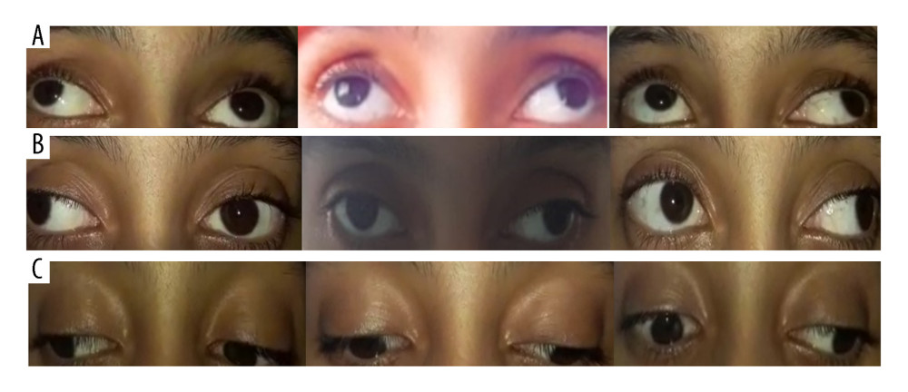 Restricted up-gaze (A), adduction (B), and downgaze (C) of the left eye in ocular motility examination.