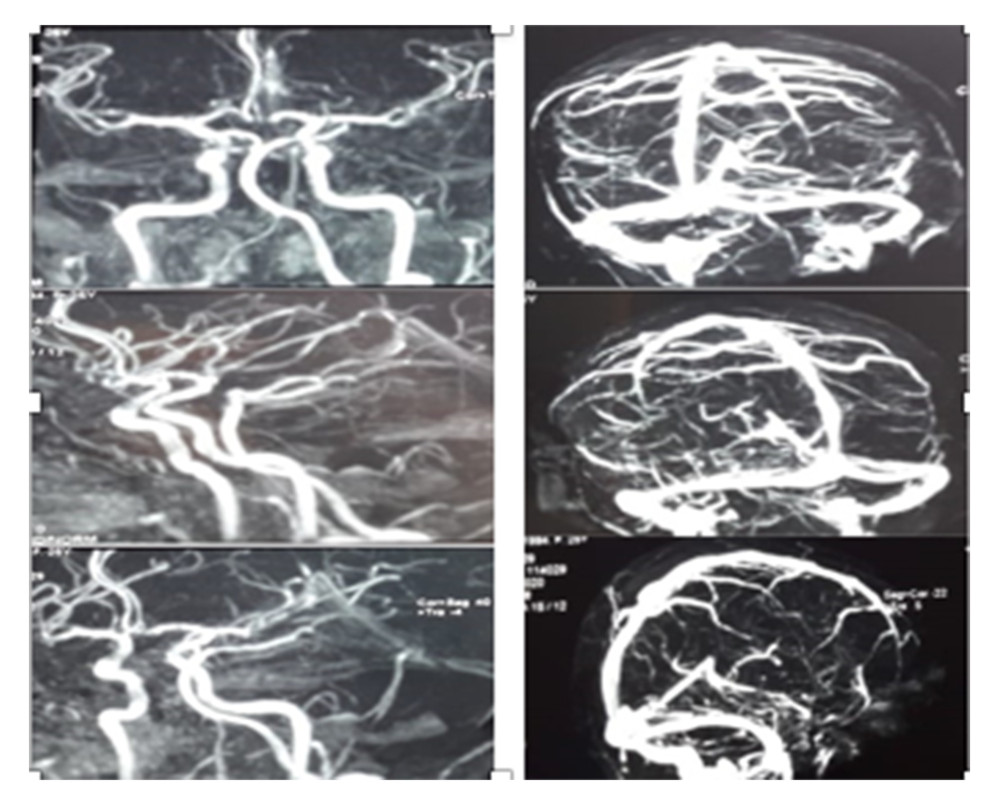 Angio-MRI of the brain and orbits revealing no lesions or aneurysmal compression of the third left cranial nerve.