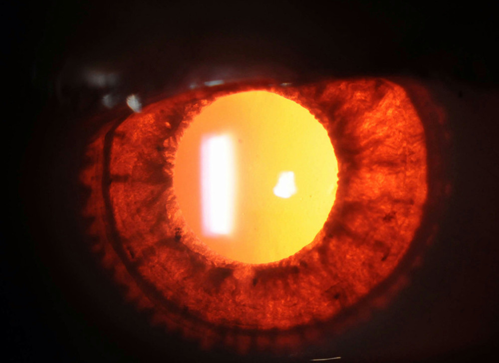 External ocular photo showing marked iris transillumination defect by retroillumination.