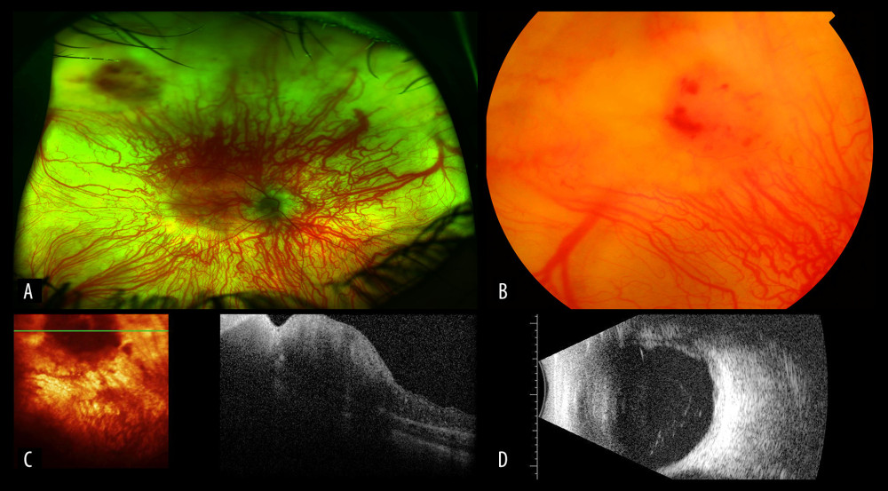 (A) Color fundus photo (Optos) showing superotemporal retinal mass near the superior arcade. (B) Color fundus photo (Topcon) showing closer image of the mass with angiomatous appearance in the superotemporal quadrant. (C) Optical coherence tomography through the lesion showing retinal elevation and thickening with no obvious choroidal abnormality. (D) Ultrasound B-scan image showing a retinal mass with apical height of 0.95 mm and a basal diameter of 3.19 mm.