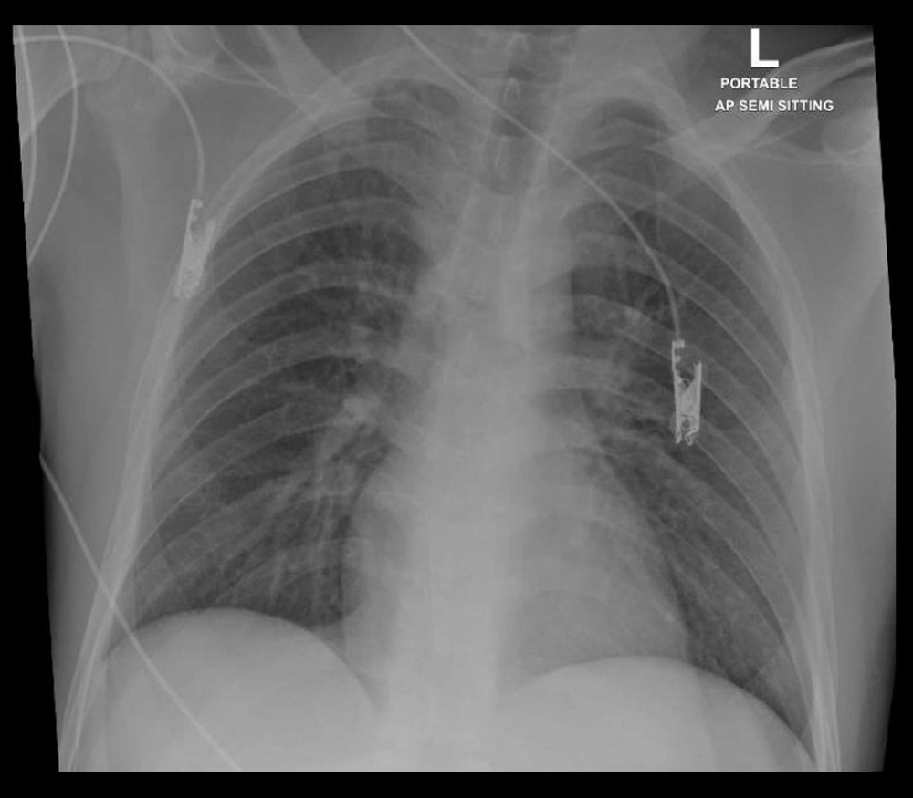 Anteroposterior chest X-ray showing normal lung parenchyma without signs of acute respiratory distress syndrome.